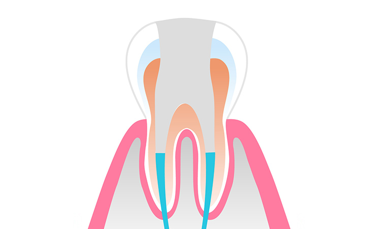 歯の寿命を延ばすMTAセメント充填