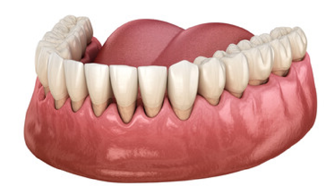 歯肉退縮治療