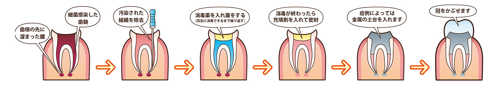 根管治療のながれ