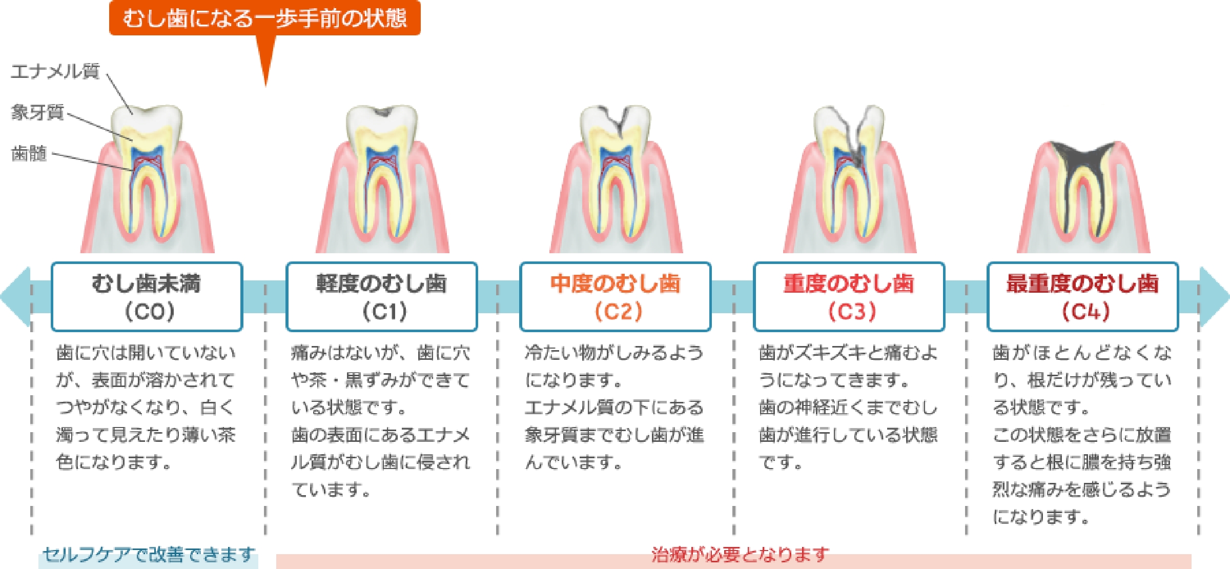 むし歯の進行とステージ