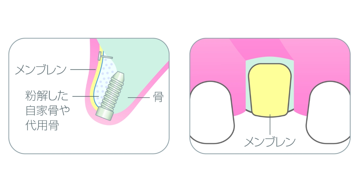 骨再生誘導法