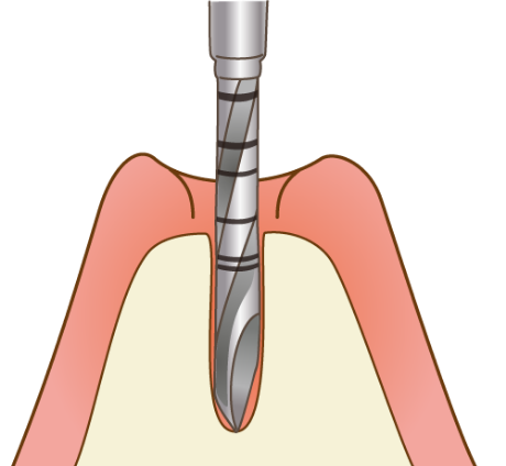 歯槽骨にフィクスチャーを埋め込むための穴をあけます
