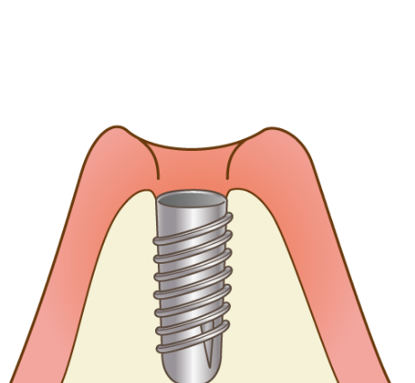 歯槽骨にあけた穴の中にフィクスチャーを埋め込みます