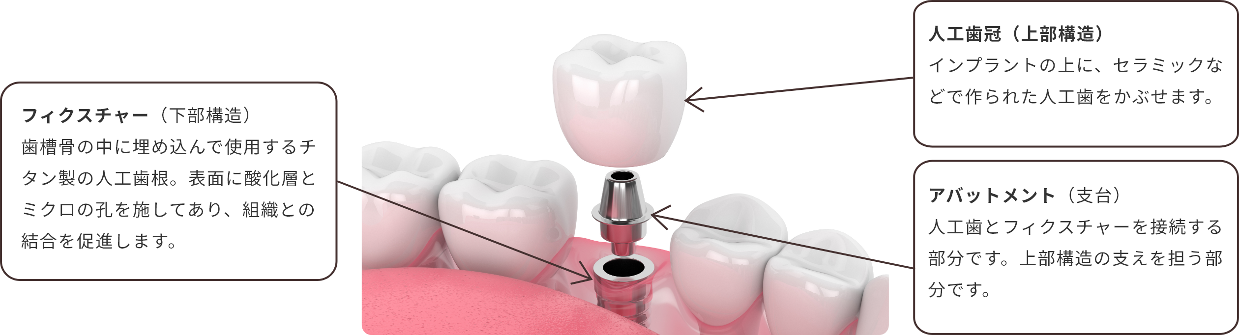 インプラントの構造と各種パーツの名称
