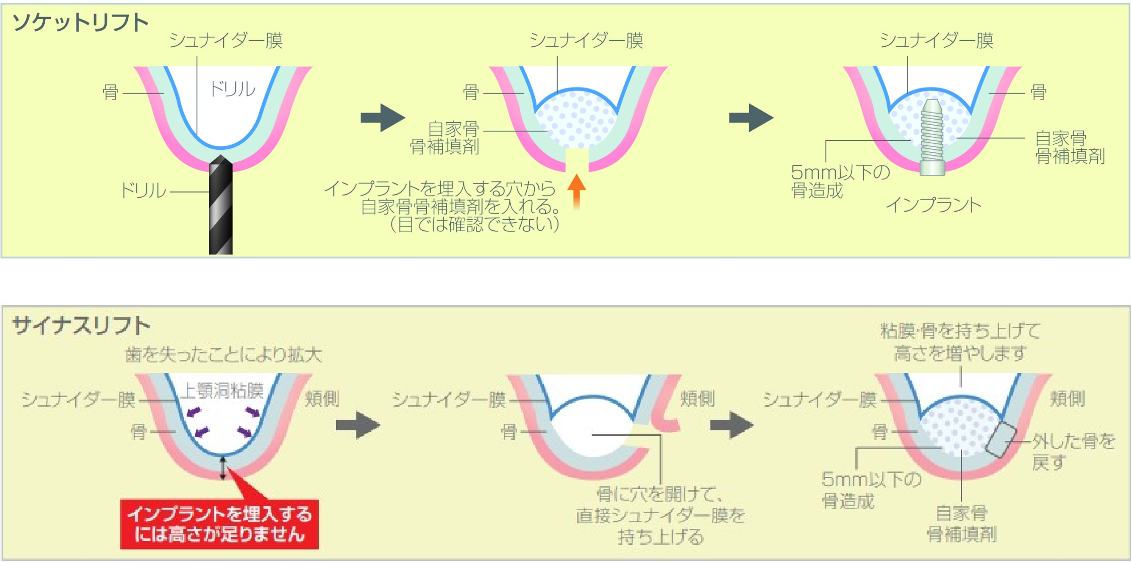 骨造成治療（上顎洞底挙上術）