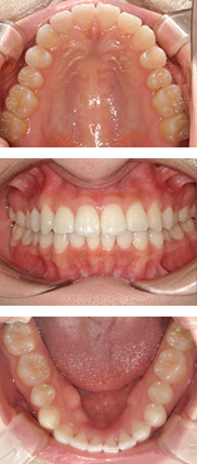 矯正後（約4ヶ月後）