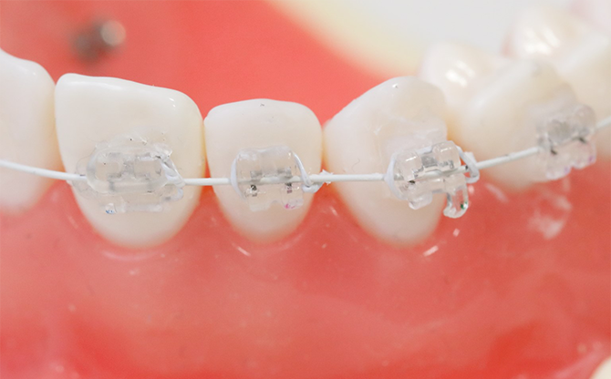 ワイヤー矯正の見本の写真