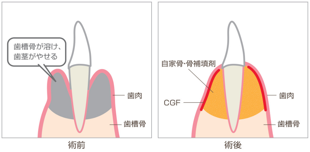 CGF