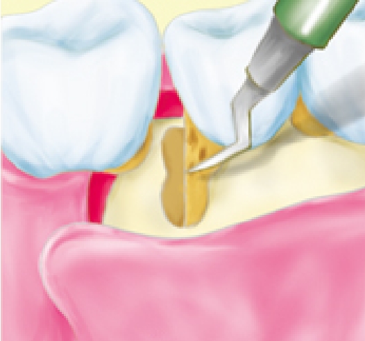 03.歯根についた汚れを除去します