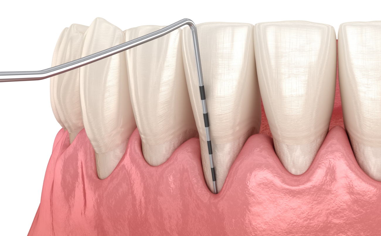 Step02  歯周病基本検査