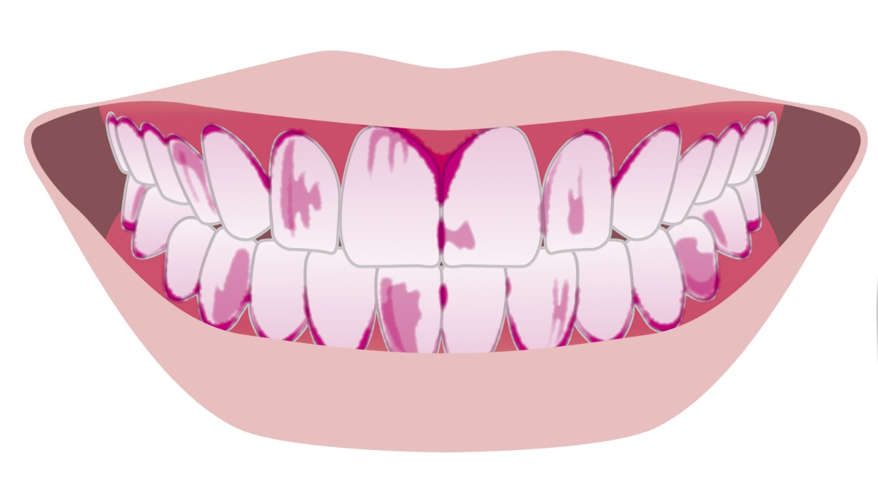歯垢の染め出し