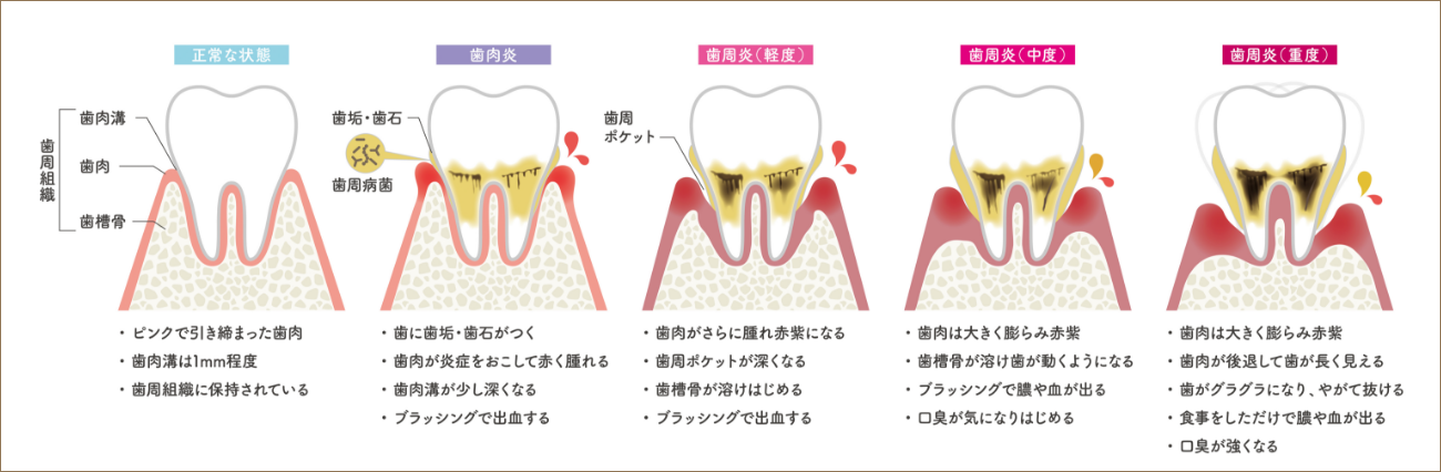 歯周病はゆっくりと進行していきます