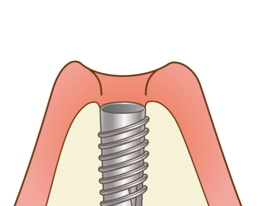 インプラント手術（1回目）