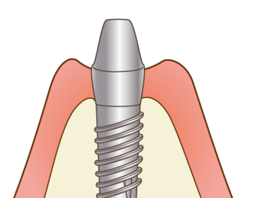 インプラント手術（2回目）