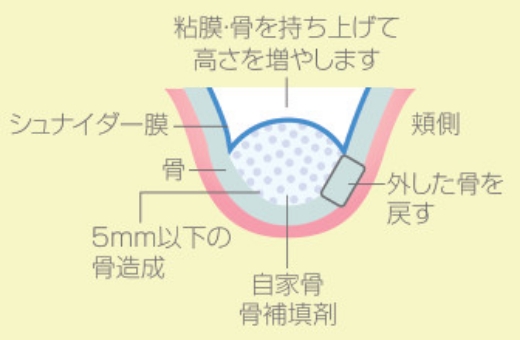 サイナスリフト