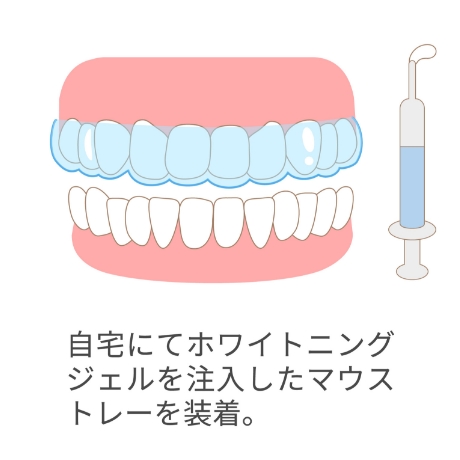 オリジナルマウスピース製作