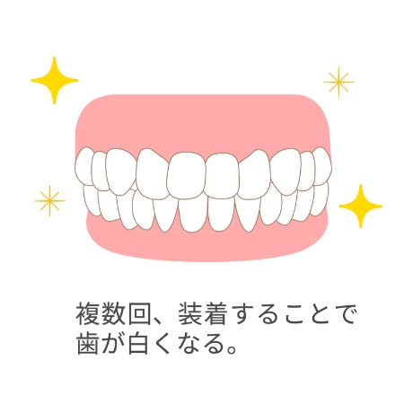 オリジナルマウスピース製作