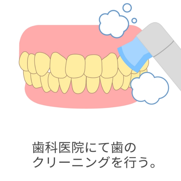オフィスホワイトニングの流れ
