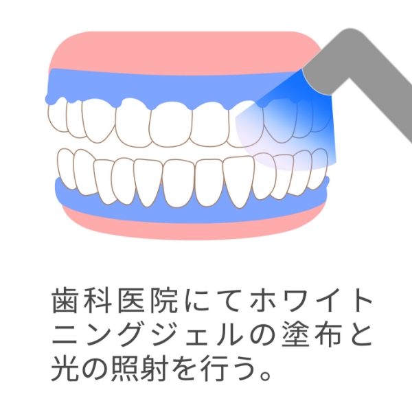 オフィスホワイトニングの流れ