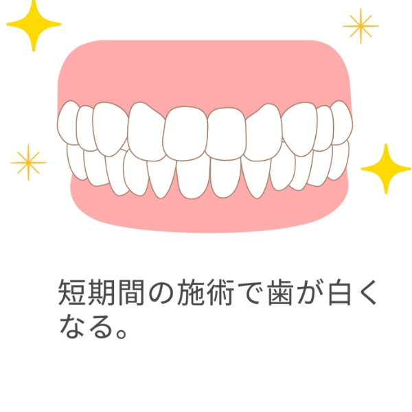 オフィスホワイトニングの流れ